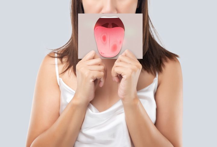 Tongue Cancer